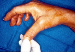 Gamekeeper Thumb Exam